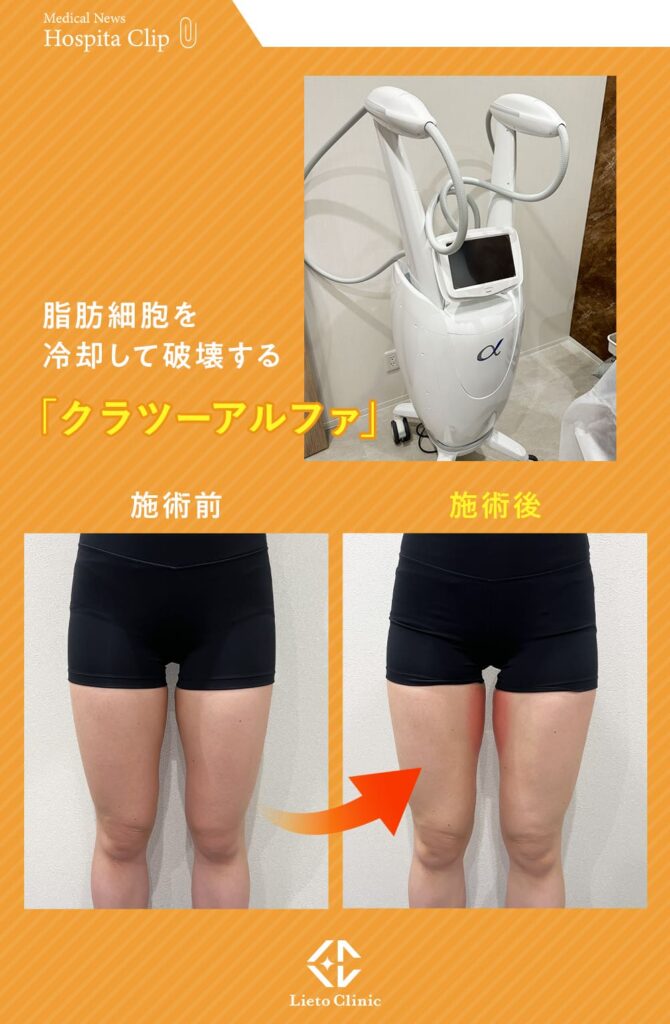 リエートクリニックのクラツーアルファ