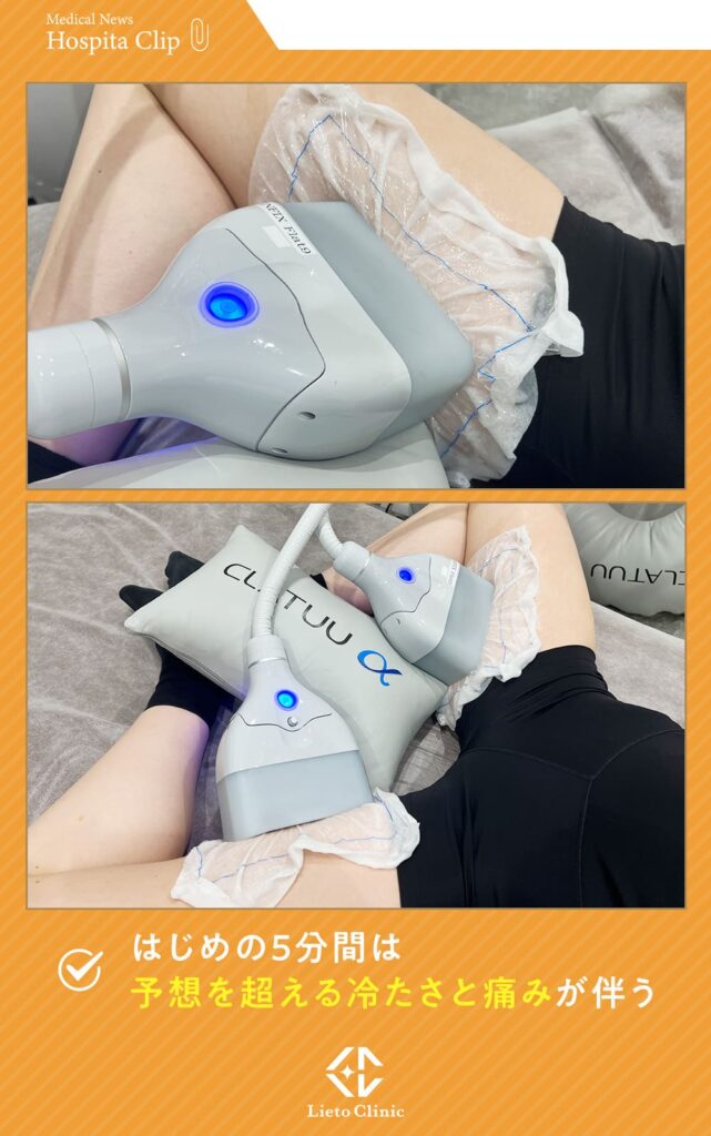 リエートクリニックでクラツーアルファ施術中